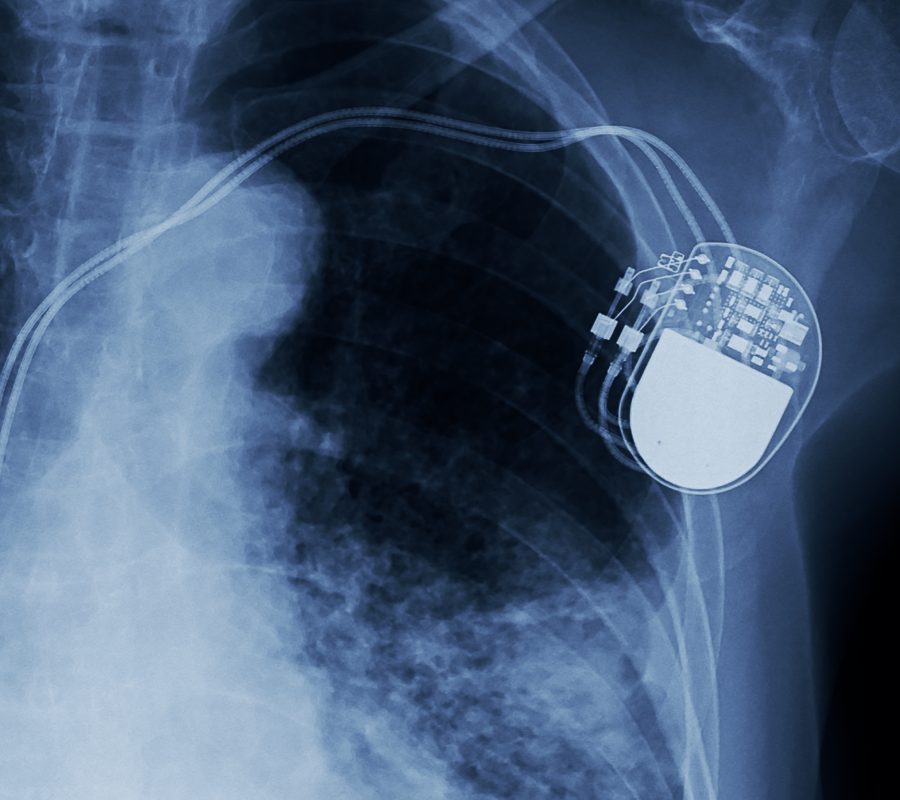 X-ray,Image,Of,Permanent,Pacemaker,Implant,In,Chest,Body,,